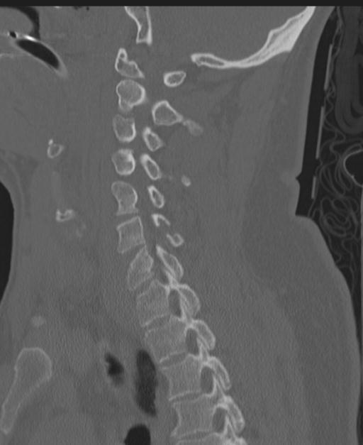 Cerebral hemorrhagic contusions and cervical spine fractures (Radiopaedia 32865-33841 Sagittal bone window 59).jpg