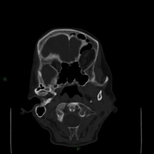 File:Cerebral metastases - breast primary (Radiopaedia 77653-89857 Axial bone window 17).jpg