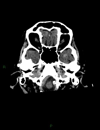 Cerebral metastases - ependymal and parenchymal (Radiopaedia 79877-93131 Axial non-contrast 5).jpg