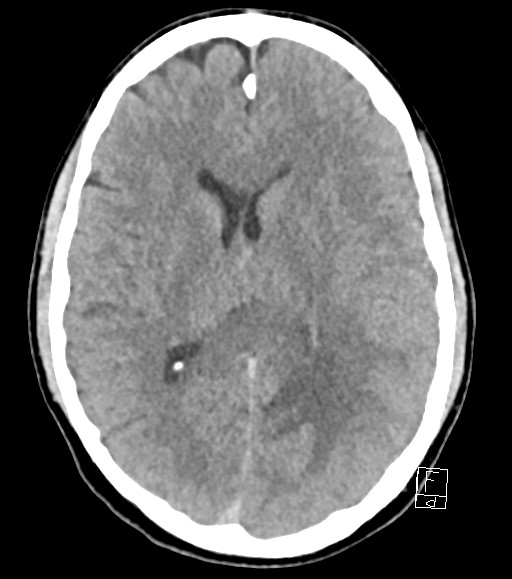 Cerebral metastases - testicular choriocarcinoma (Radiopaedia 84486-99855 Axial non-contrast 27).jpg