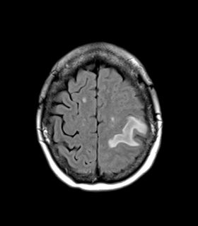 File:Cerebral metastasis (Radiopaedia 46744-51248 Axial FLAIR 23).png