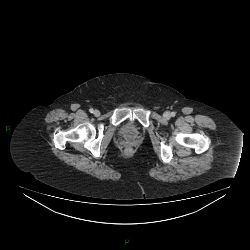 Cerebral metastasis from renal cell carcinoma (Radiopaedia 82306-96378 A 192).jpg
