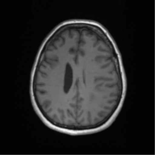 Cerebral metastasis mimicking glioblastoma (Radiopaedia 69155-78937 Axial T1 45).png