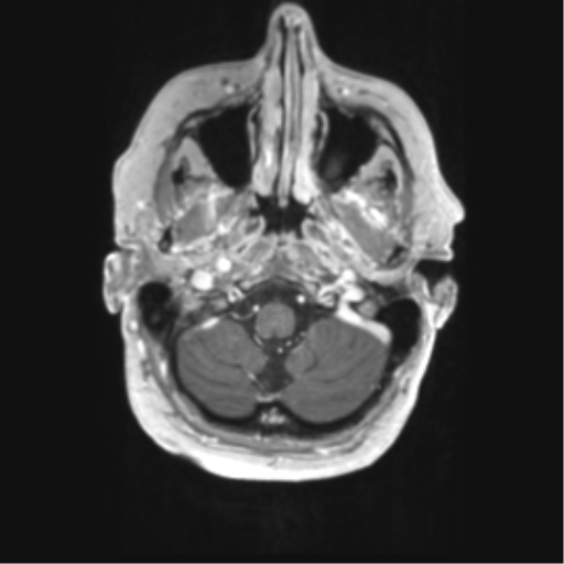 Cerebral metastasis mimicking glioblastoma (Radiopaedia 69155-78937 Axial T1 C+ 4).png