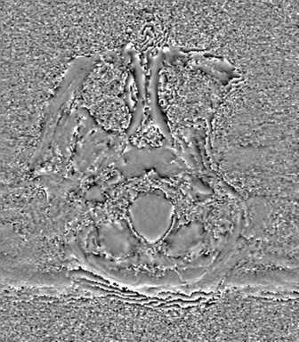 Cerebral metastasis to basal ganglia (Radiopaedia 81568-95413 Axial SWI phase 4).png