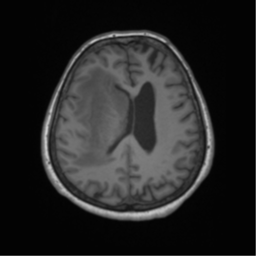 Cerebral metastasis to basal ganglia (Radiopaedia 81568-95413 Axial T1 48).png