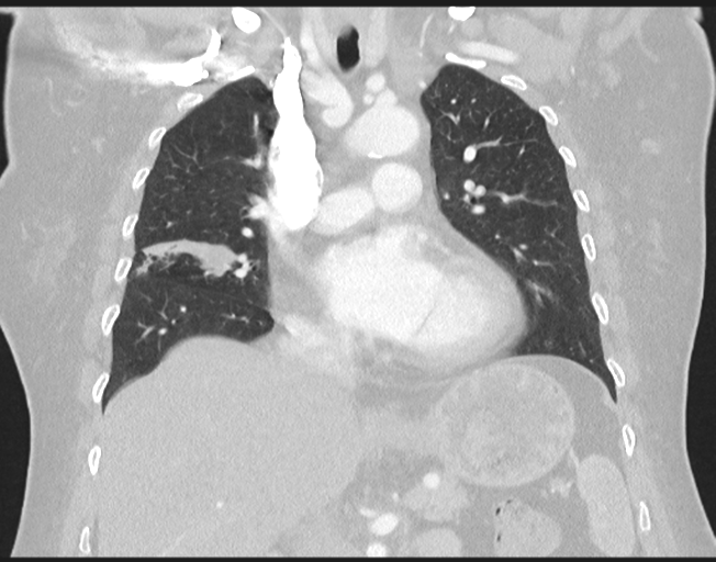 File:Cerebral metastasis to basal ganglia (Radiopaedia 81568-95414 Coronal lung window 41).png