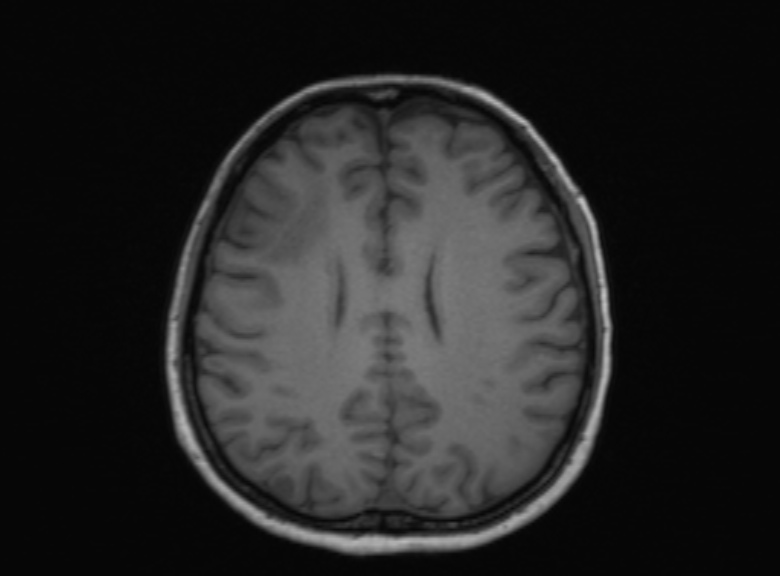 Cerebral ring enhancing lesions - cerebral metastases (Radiopaedia 44922-48817 Axial T1 185).jpg