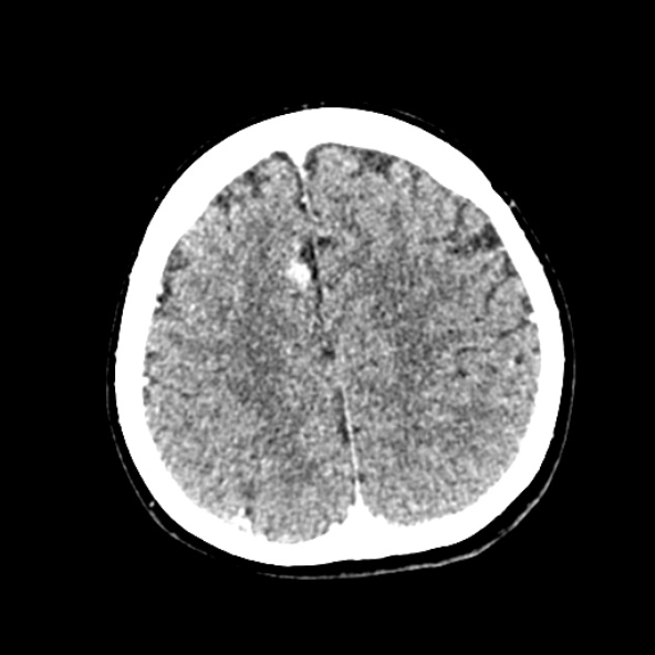 Cerebral ring enhancing lesions - cerebral metastases (Radiopaedia 44922-48818 B 210).jpg