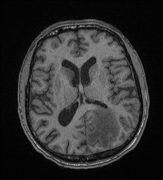 File:Cerebral toxoplasmosis (Radiopaedia 43956-47461 Axial T1 43).jpg