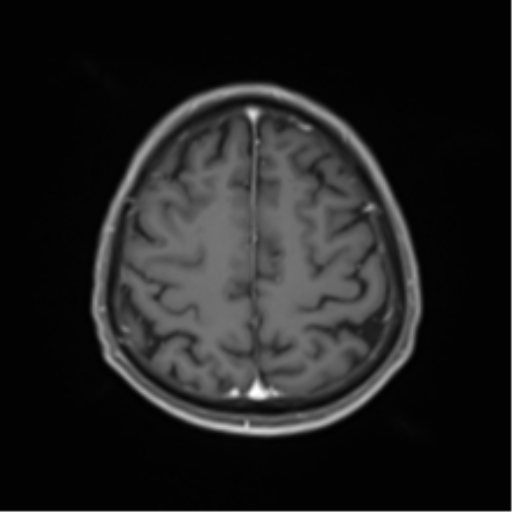 Cerebral toxoplasmosis (Radiopaedia 54575-60804 Axial T1 C+ 43).png
