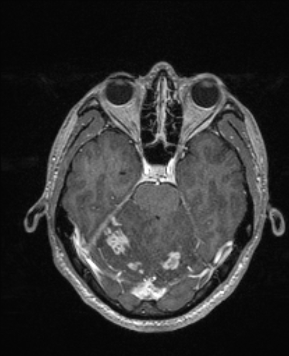 Cerebral toxoplasmosis (Radiopaedia 85779-101597 Axial T1 C+ 54).jpg