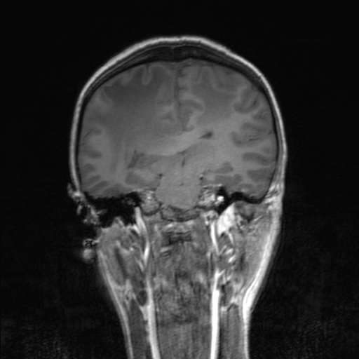 Cerebral tuberculosis with dural sinus invasion (Radiopaedia 60353-68090 Coronal T1 107).jpg