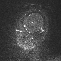 Cerebral tuberculosis with dural sinus invasion (Radiopaedia 60353-68090 Sagittal MRV 139).jpg