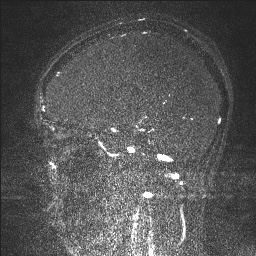 Cerebral tuberculosis with dural sinus invasion (Radiopaedia 60353-68090 Sagittal MRV 94).jpg