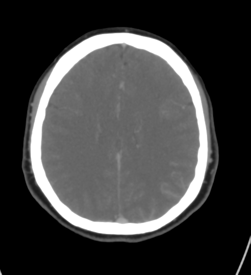 File:Cerebral venous infarction due to transverse sinus thrombosis (Radiopaedia 34688-36120 Axial CT venogram 33).png