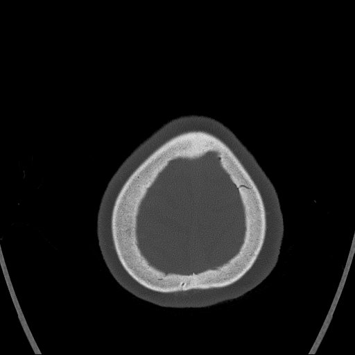 Cerebral venous infarction with hemorrhage (Radiopaedia 65343-74381 Axial bone window 179).jpg