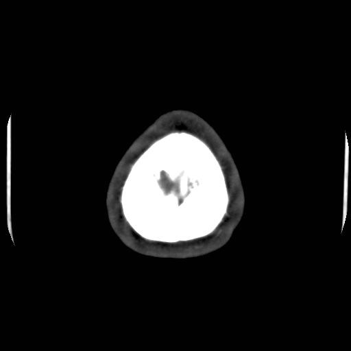 Cerebral venous sinus thrombosis (Radiopaedia 40619-43227 A 223).jpg