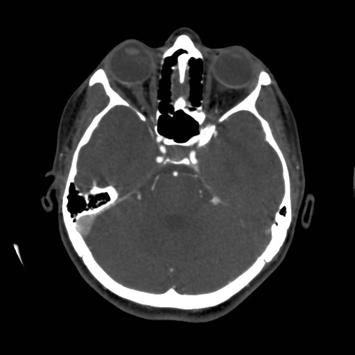 Cerebral venous sinus thrombosis (Radiopaedia 40619-43227 A 72).jpg