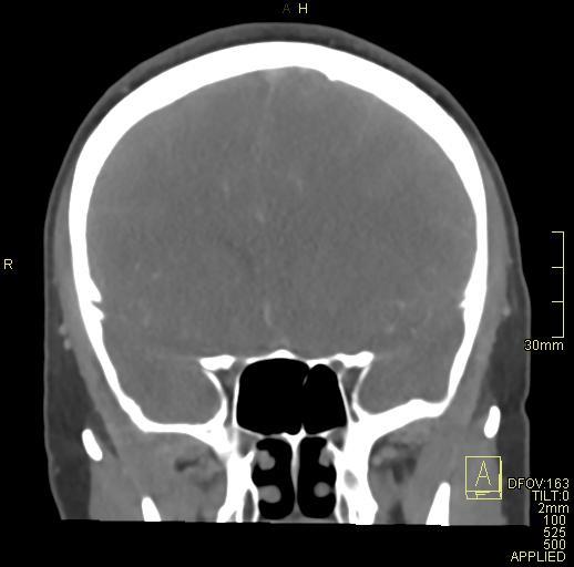 File:Cerebral venous sinus thrombosis (Radiopaedia 91329-108965 Coronal venogram 32).jpg