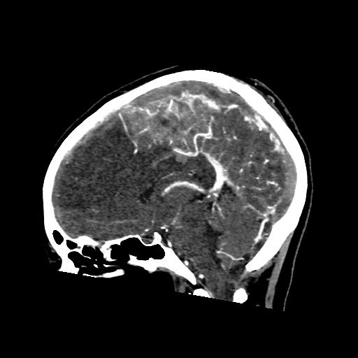 File:Cerebral venous throbmosis - hemorrhagic venous infarction (Radiopaedia 87318-103613 Sagittal CT venogram 23).jpg
