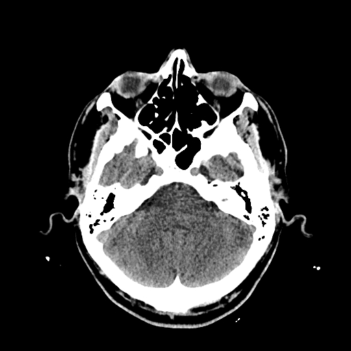 File:Cerebral venous thrombosis (CVT) (Radiopaedia 77524-89685 Axial non-contrast 11).jpg