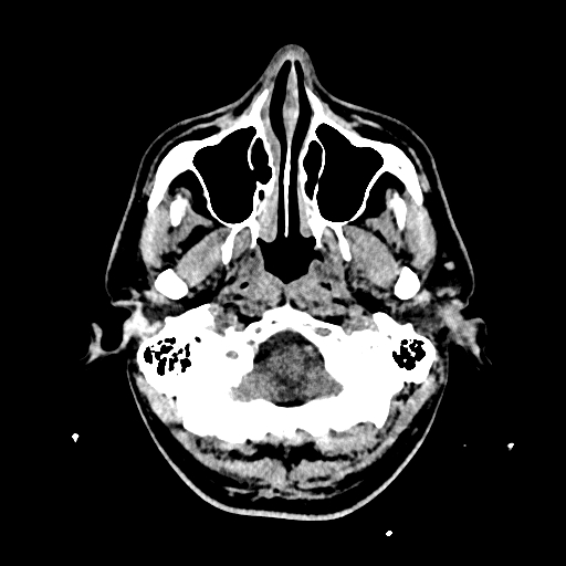 File:Cerebral venous thrombosis (CVT) (Radiopaedia 77524-89685 Axial non-contrast 4).jpg