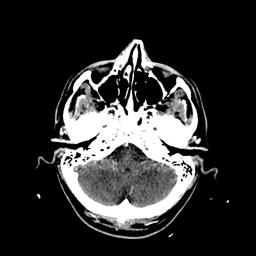 File:Cerebral venous thrombosis (CVT) (Radiopaedia 77524-89685 Axial with contrast 8).jpg