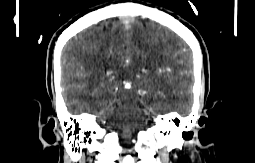 File:Cerebral venous thrombosis (CVT) (Radiopaedia 77524-89685 C 40).jpg