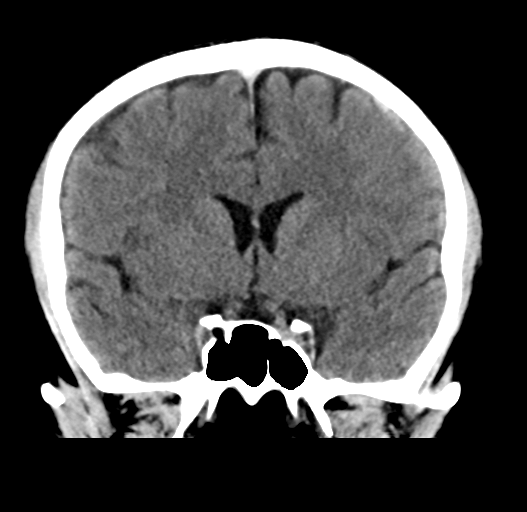 File:Cerebral venous thrombosis (Radiopaedia 38392-40467 Coronal non-contrast 16).png