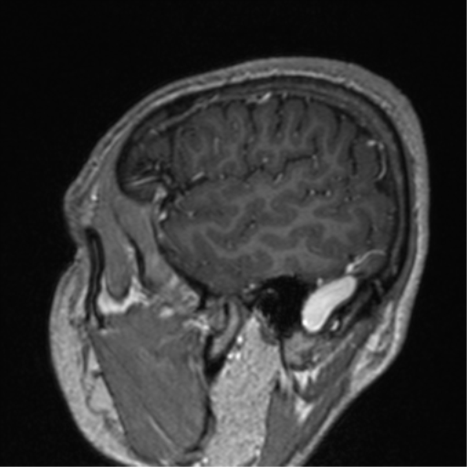 Cerebral venous thrombosis (Radiopaedia 38392-40469 Sagittal T1 C+ 18).png