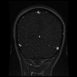 Cerebral venous thrombosis - ulcerative colitis (Radiopaedia 66049-75219 Coronal MRV 33).jpg