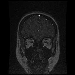 Cerebral venous thrombosis - ulcerative colitis (Radiopaedia 66049-75219 Coronal MRV 95).jpg