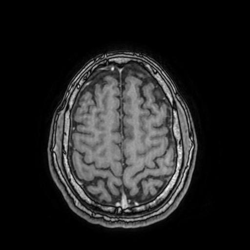 File:Cerebral venous thrombosis with secondary intracranial hypertension (Radiopaedia 89842-106957 Axial T1 C+ 136).jpg