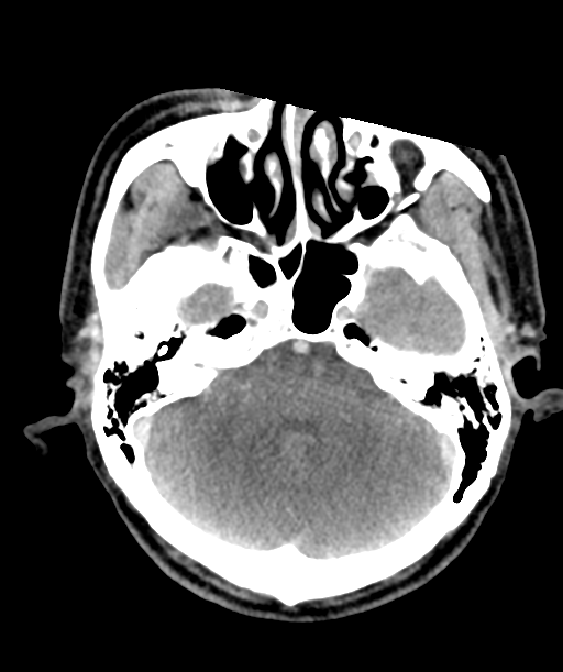 Cervical abscess (Radiopaedia 43725-47184 A 2).png