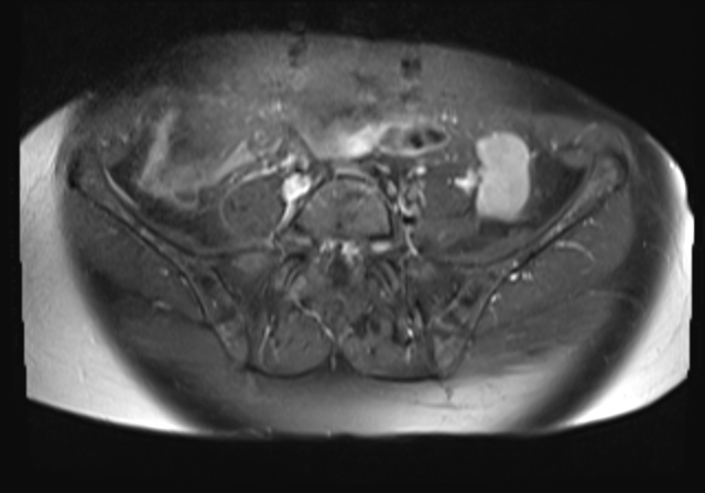 File:Cervical carcinoma (Radiopaedia 88312-104943 Axial T1 C+ fat sat 3).jpg