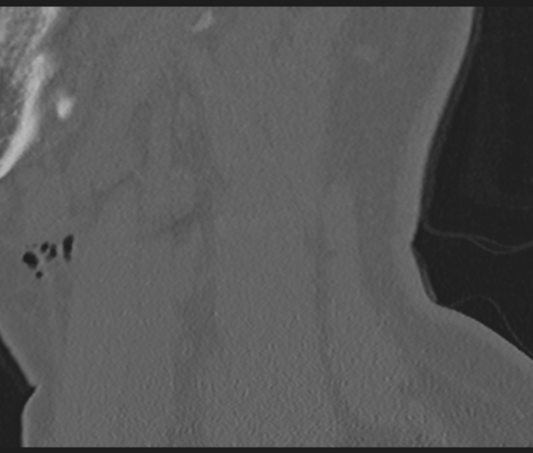 Cervical disc replacement (Radiopaedia 44025-47541 Sagittal bone window 72).png