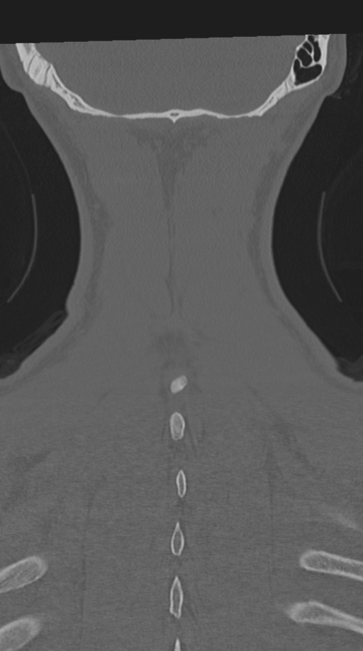 Cervical intercalary bone (Radiopaedia 35211-36748 Coronal bone window 70).png