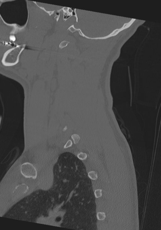 Cervical intercalary bone (Radiopaedia 35211-36748 Sagittal bone window 64).png