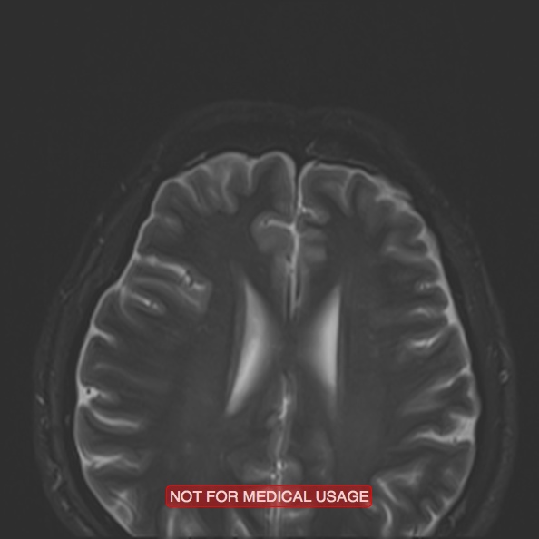 Cervical nerve schwannoma (Radiopaedia 27964-28221 C 2).jpg