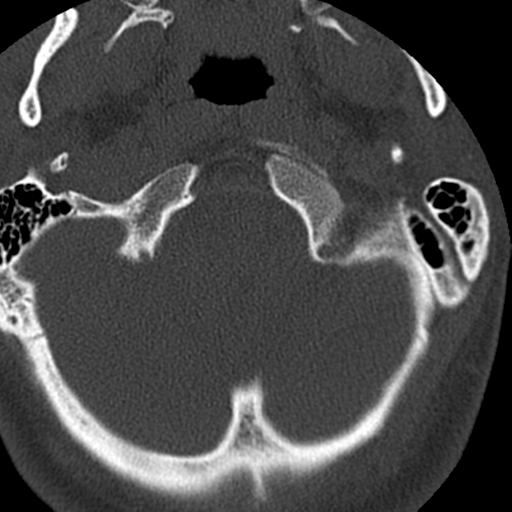 File:Cervical schwannoma (Radiopaedia 57979-64974 Axial bone window 8).png