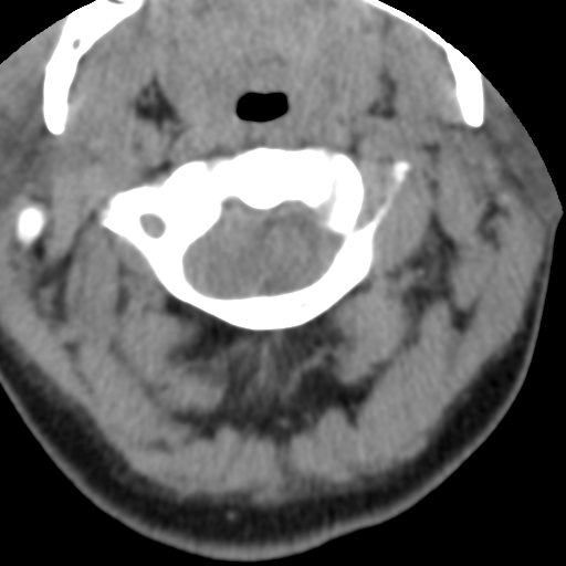 Cervical schwannoma (Radiopaedia 57979-64974 Axial non-contrast 16).png