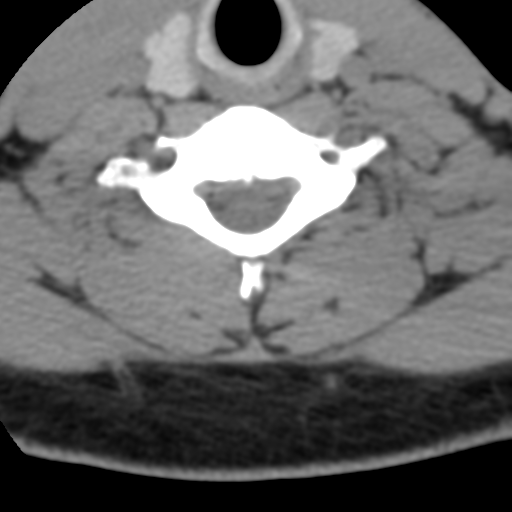 File:Cervical schwannoma (Radiopaedia 57979-64974 Axial non-contrast 48).png