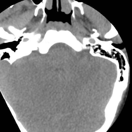 Cervical schwannoma (Radiopaedia 57979-64974 Axial non-contrast 5).png
