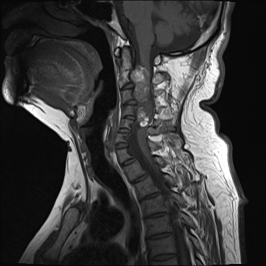 File:Cervical spinal neurofibroma in a patient with NF1 (Radiopaedia 58344-65465 Sagittal T1 5).jpg
