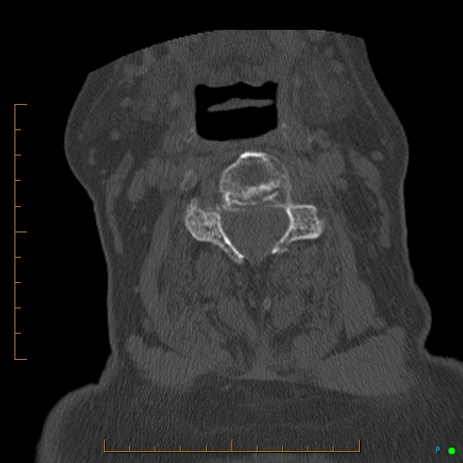 File:Cervical spine fracture - ankylosing spondylitis (Radiopaedia 76835-88706 Axial bone window 98).jpg