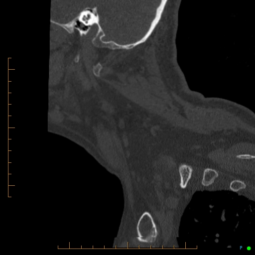 Cervical spine fracture - ankylosing spondylitis (Radiopaedia 76835-88706 Sagittal bone window 100).jpg