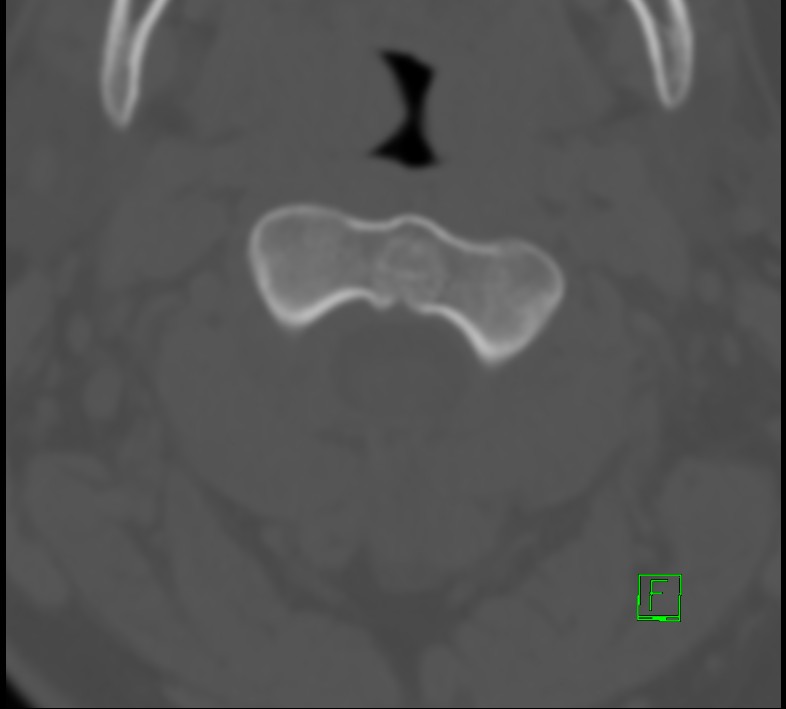 Cervical spine fracture - hyperflexion injury (Radiopaedia 66184-75364 Axial bone window 5).jpg