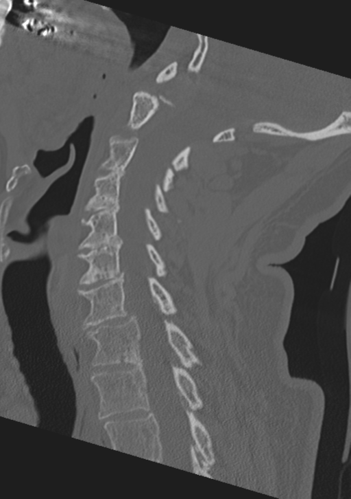 Cervical spine fractures with vertebral artery dissection (Radiopaedia 53296-59268 Sagittal bone window 29).png