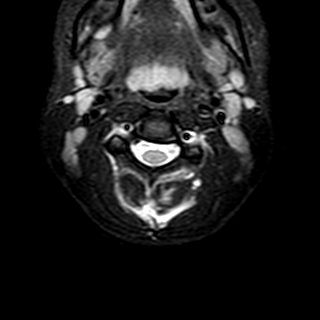 File:Cervical spine posterior ligamentous complex rupture (Radiopaedia 63486-72103 Axial T2 17).jpg